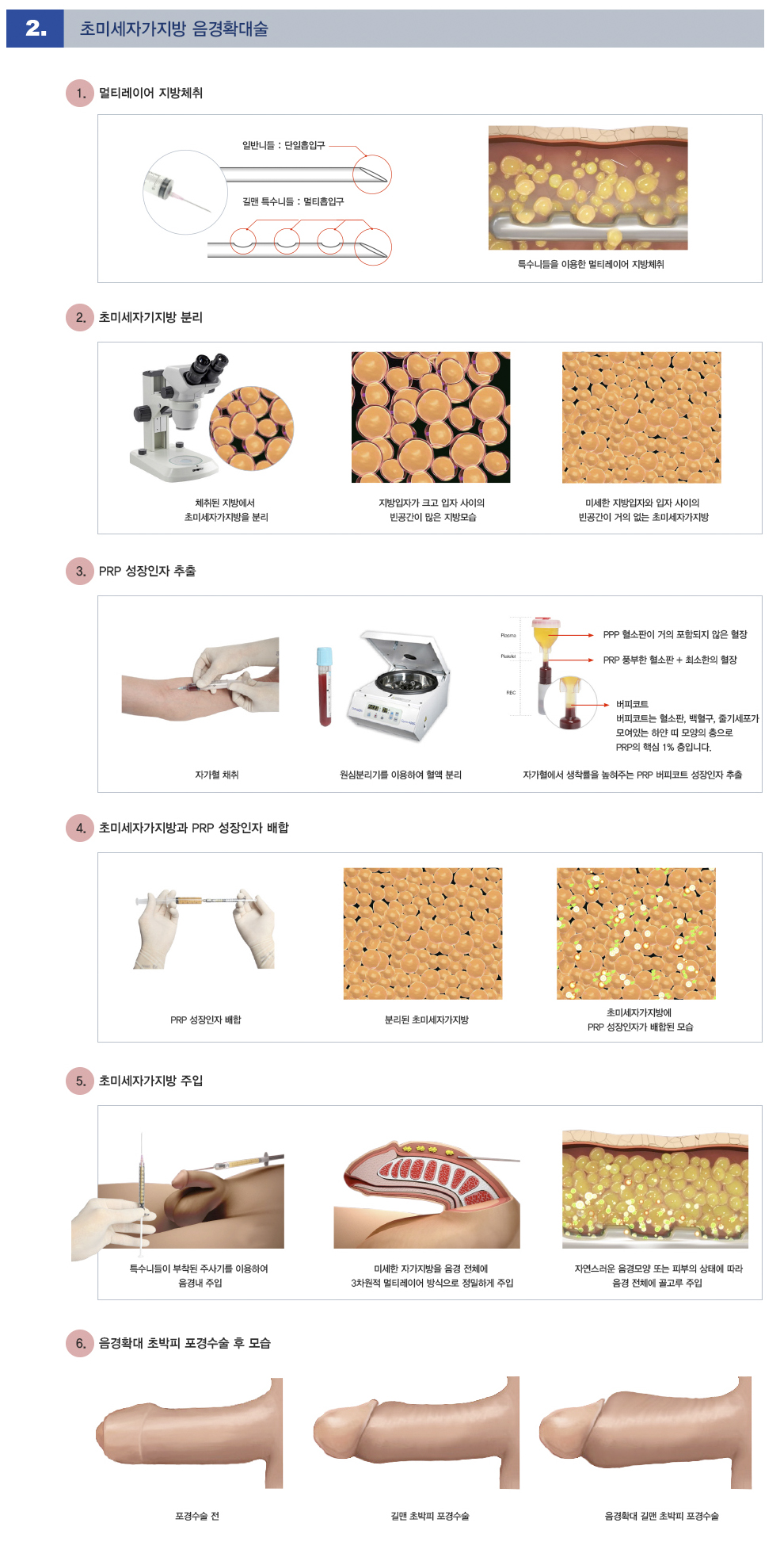 음경확대포경수술