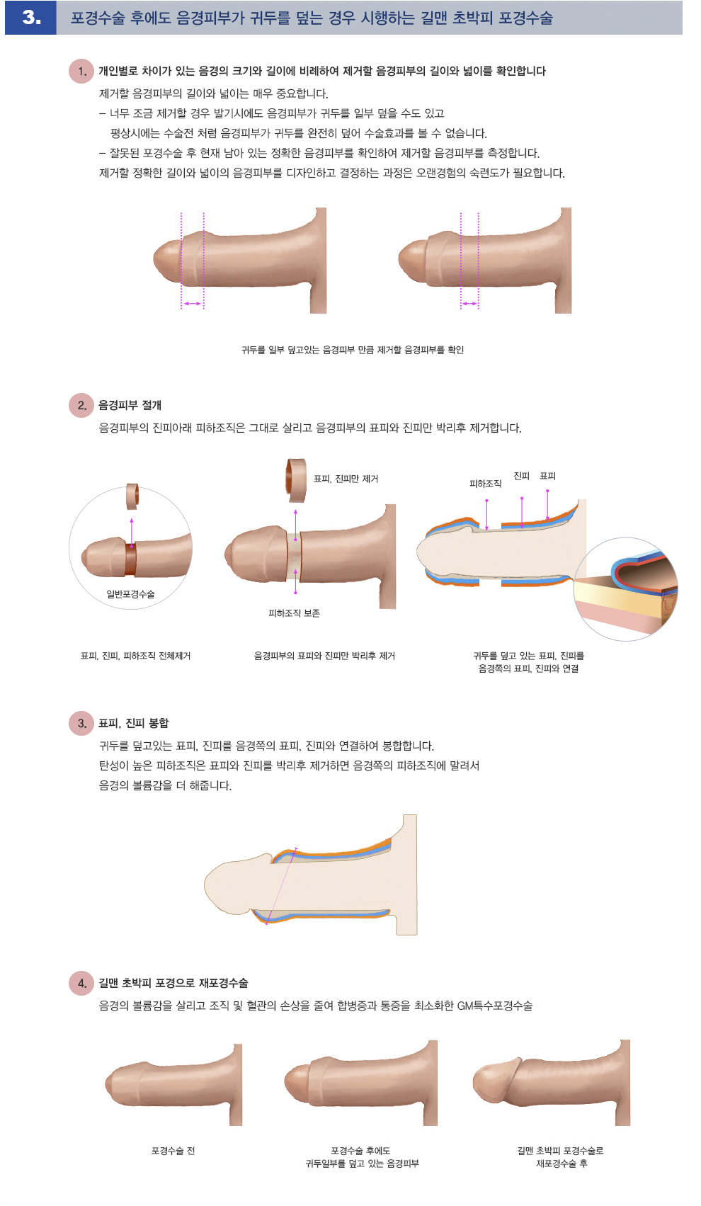 재포경복원수술
