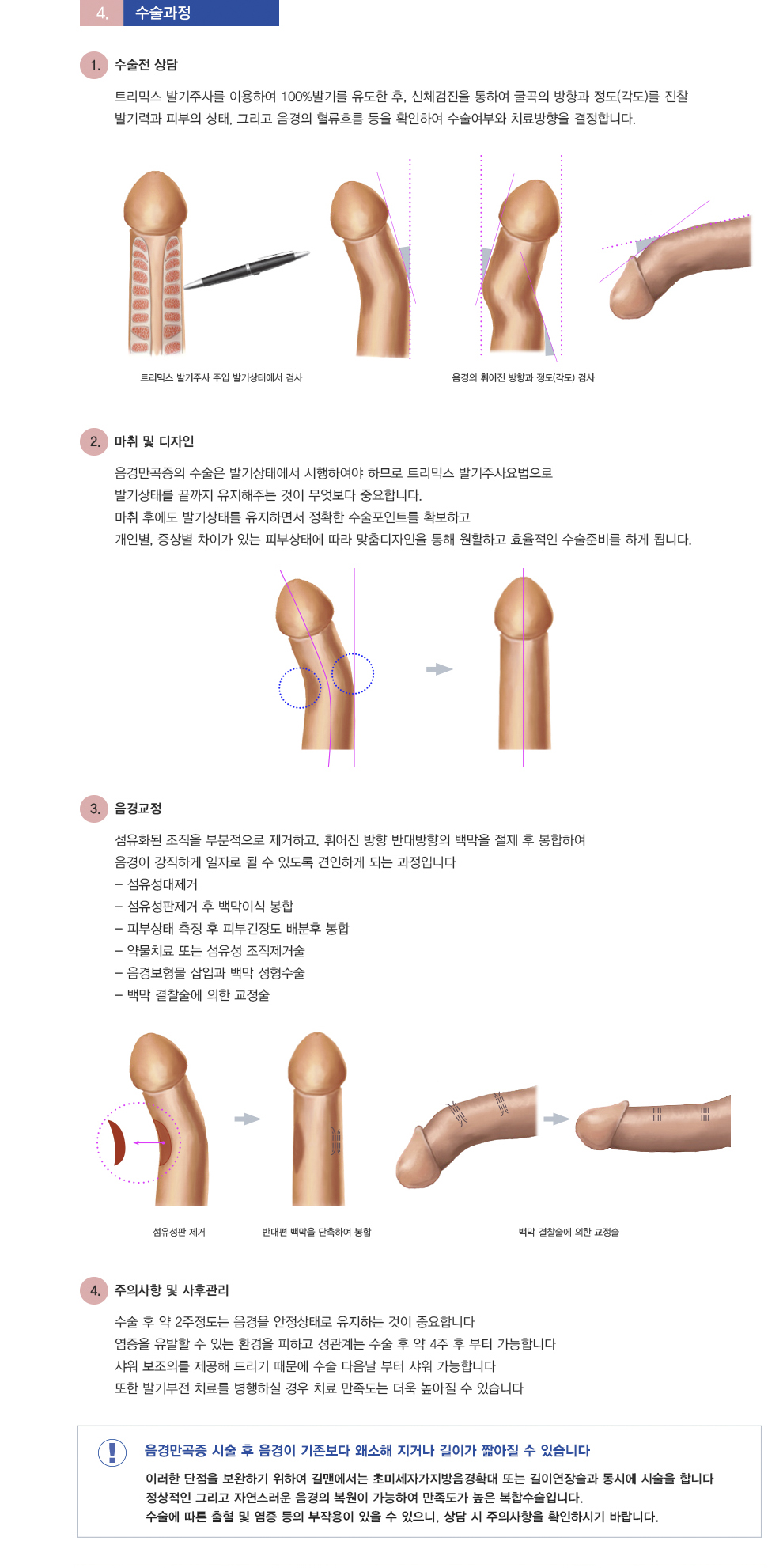음경만곡증